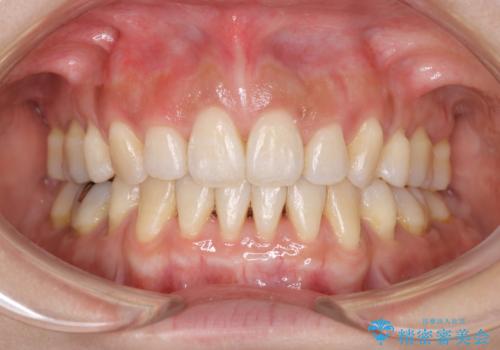 出っ歯で口が閉じずらい ワイヤー抜歯矯正の治療後