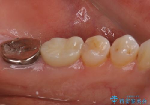 他院で仮歯までしたが、放置していたためセラミック入れたい セラミック治療の治療後