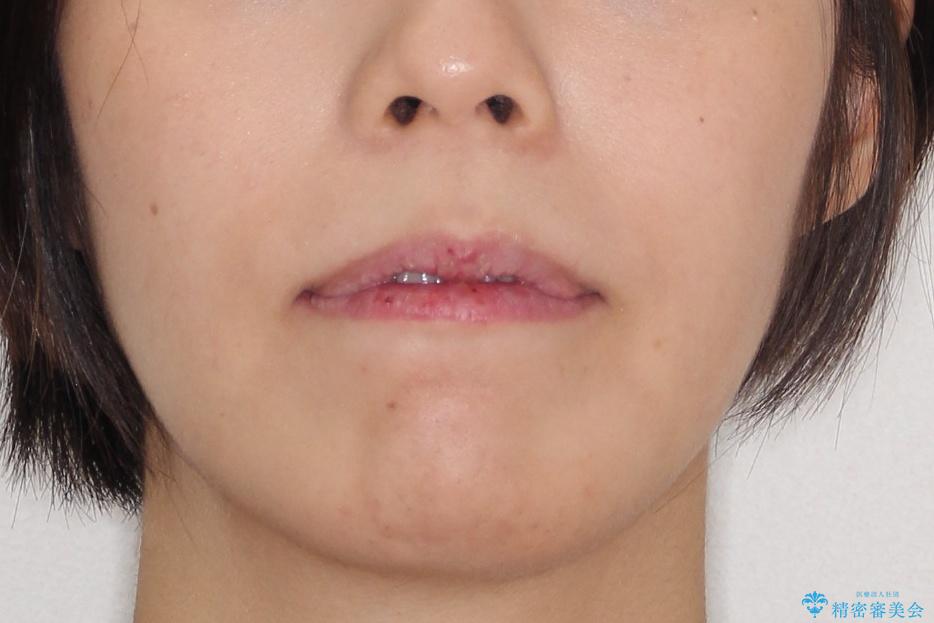 【出っ歯が気になる】インビザライン症例の治療後(顔貌)