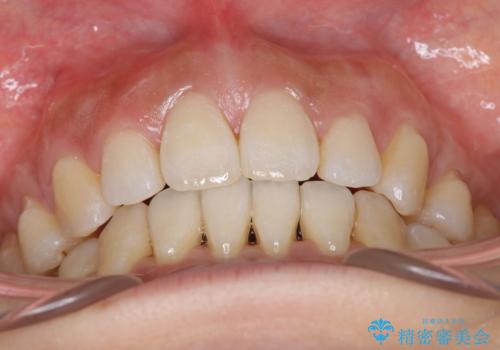 出っ歯で口が閉じずらい　ワイヤー抜歯矯正の治療後