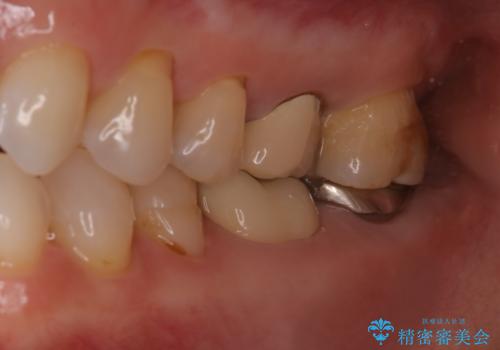 他院で仮歯までしたが、放置していたためセラミック入れたい セラミック治療の治療後