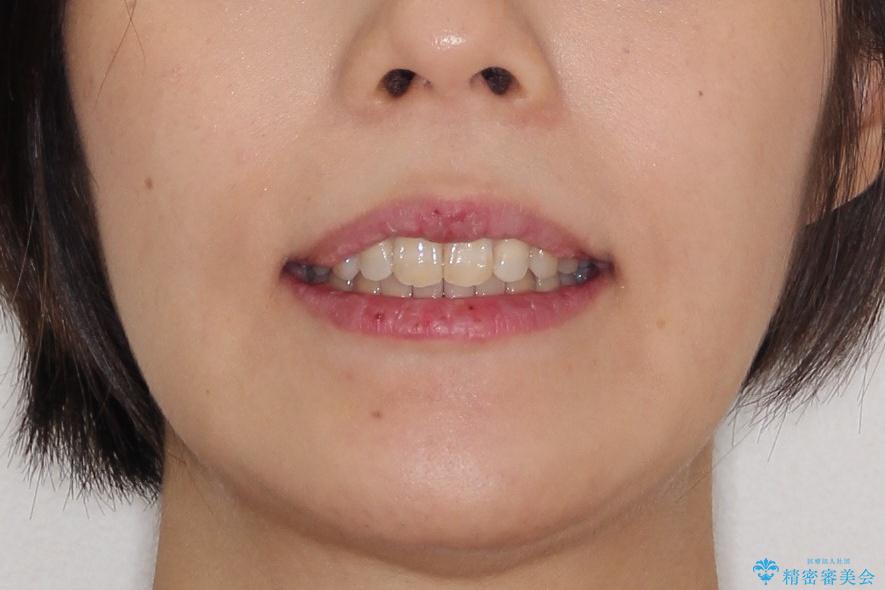 【出っ歯が気になる】インビザライン症例の治療後(顔貌)