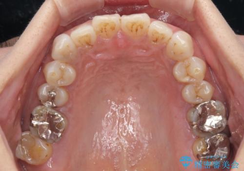 極端な上下前歯の開咬を改善　オープンバイトのインビザライン矯正の治療前