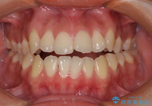 受け口と開咬を急速拡大装置とワイヤー装置で改善の症例 治療前