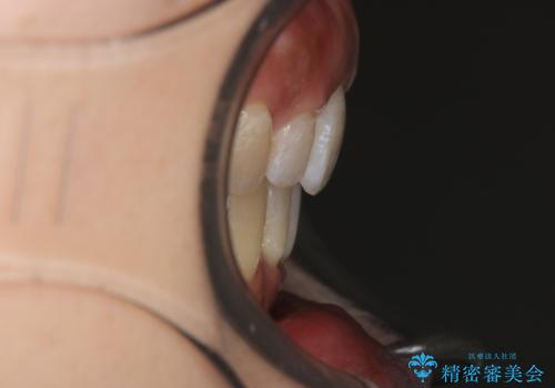 出っ歯で口が閉じずらい ワイヤー抜歯矯正の治療後