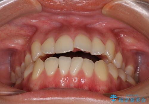 受け口と開咬を急速拡大装置とワイヤー装置で改善の治療前