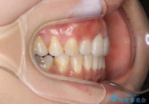 出っ歯で口が閉じずらい　ワイヤー抜歯矯正の症例 治療後