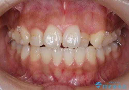 【引っ込んだ前歯が気になる、真ん中の線も揃えたい】インビザライン症例の治療中