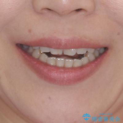 極端な上下前歯の開咬を改善　オープンバイトのインビザライン矯正の治療前（顔貌）