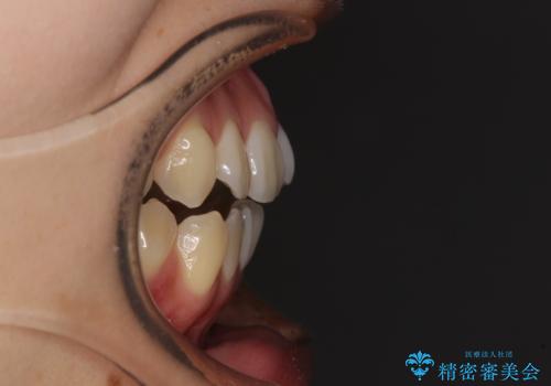 受け口と開咬を急速拡大装置とワイヤー装置で改善の治療前