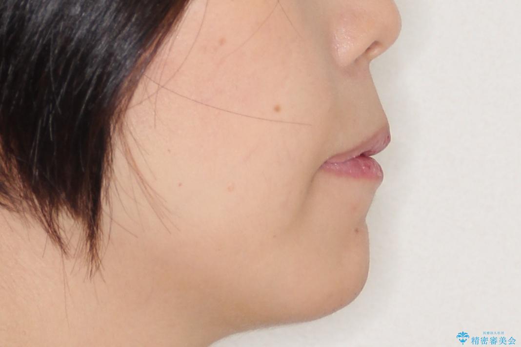 【出っ歯が気になる】インビザライン症例の治療後(顔貌)