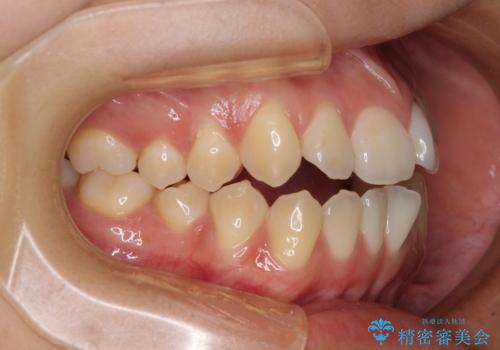 受け口と開咬を急速拡大装置とワイヤー装置で改善の治療前