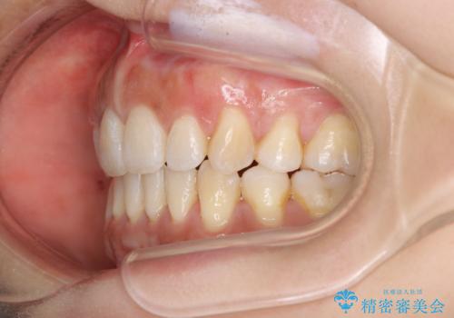 出っ歯で口が閉じずらい ワイヤー抜歯矯正の治療後