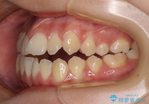 受け口と開咬を急速拡大装置とワイヤー装置で改善の治療前