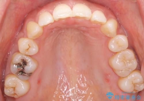 出っ歯で口が閉じずらい　ワイヤー抜歯矯正の治療後