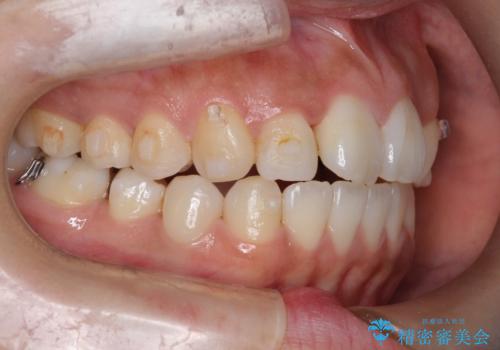 【引っ込んだ前歯が気になる、真ん中の線も揃えたい】インビザライン症例の治療中