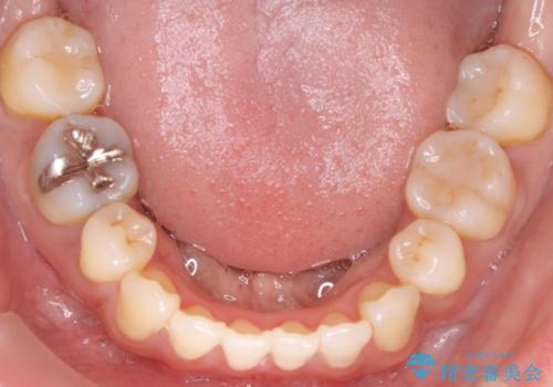出っ歯で口が閉じずらい ワイヤー抜歯矯正の治療後