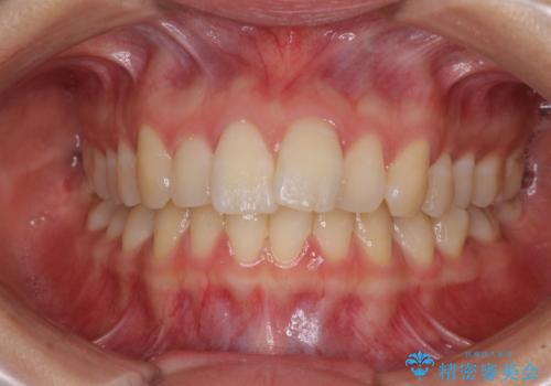 【モニター】飛び出した上顎前歯のワイヤー矯正で改善の治療前