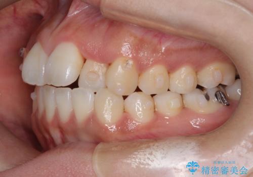 【引っ込んだ前歯が気になる、真ん中の線も揃えたい】インビザライン症例の治療中