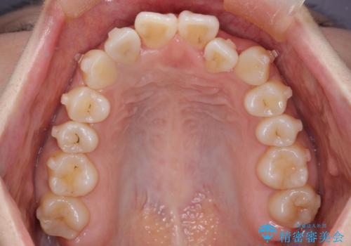 【引っ込んだ前歯が気になる、真ん中の線も揃えたい】インビザライン症例の治療中