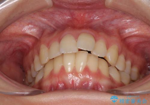 【モニター】飛び出した上顎前歯のワイヤー矯正で改善の治療前