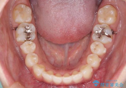 【引っ込んだ前歯が気になる、真ん中の線も揃えたい】インビザライン症例の治療中