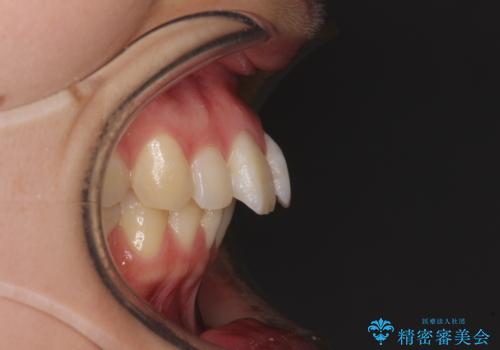 【モニター】飛び出した上顎前歯のワイヤー矯正で改善の治療前