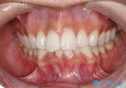 【インビザライン】前歯の凸凹をIPRで改善の症例 治療前