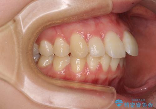 【モニター】飛び出した上顎前歯のワイヤー矯正で改善の治療前