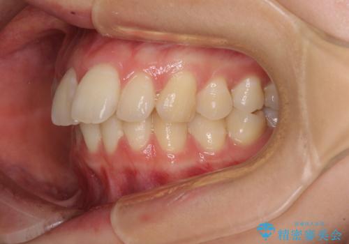 【モニター】飛び出した上顎前歯のワイヤー矯正で改善の治療前