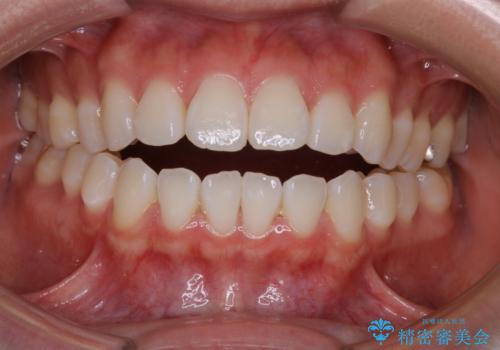 前歯で噛めない:オープンバイト(開咬)を非抜歯インビザラインで治療の治療前