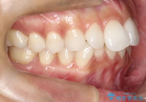 【インビザライン】前歯の凸凹をIPRで改善の治療前