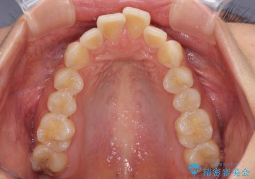 【モニター】飛び出した上顎前歯のワイヤー矯正で改善の治療前