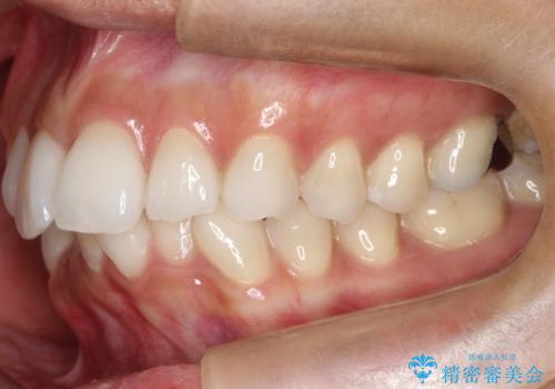 【インビザライン】前歯の凸凹をIPRで改善の治療前
