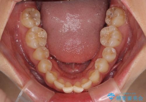 【モニター】飛び出した上顎前歯のワイヤー矯正で改善の治療前