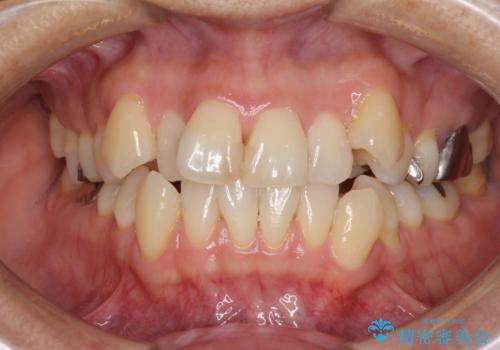 八重歯で口元が膨れている　ワイヤー装置での抜歯矯正の症例 治療前