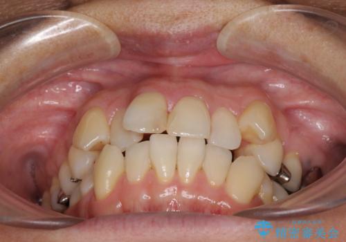 八重歯で口元が膨れている　ワイヤー装置での抜歯矯正の治療前