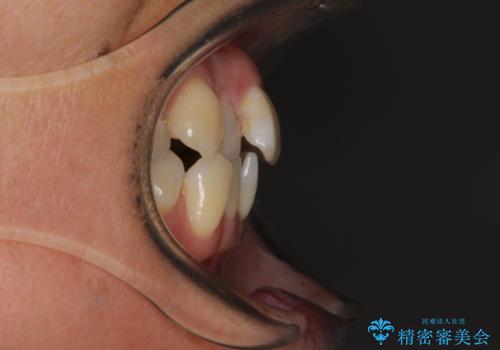 八重歯で口元が膨れている ワイヤー装置での抜歯矯正の治療前