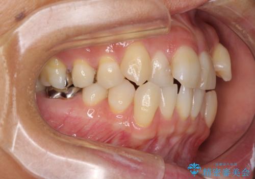 八重歯で口元が膨れている ワイヤー装置での抜歯矯正の治療前