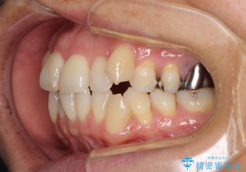八重歯で口元が膨れている ワイヤー装置での抜歯矯正の治療前