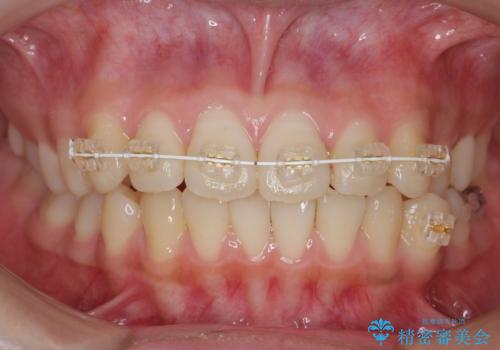 前歯のがたつき 部分矯正でコストダウンしながら、かみ合わせも治療の治療中