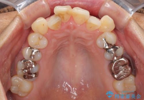 八重歯で口元が膨れている ワイヤー装置での抜歯矯正の治療前