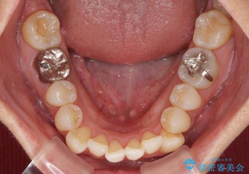 八重歯で口元が膨れている　ワイヤー装置での抜歯矯正の治療前