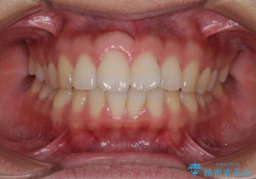 前歯の出っ歯と口の閉じにくさが気になる　目立たないワイヤー装置での抜歯矯正の治療前