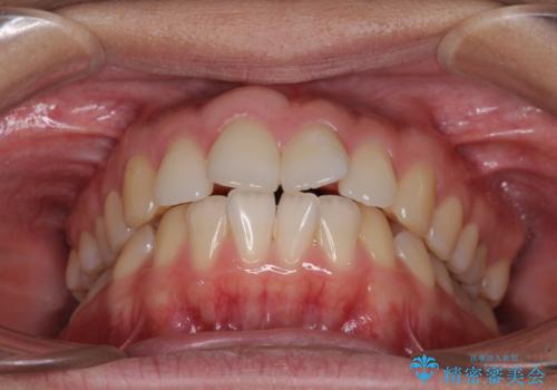 前歯の出っ歯と口の閉じにくさが気になる 目立たないワイヤー装置での抜歯矯正の治療前