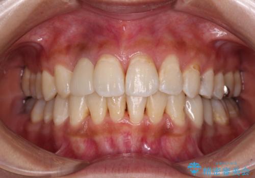 デコボコで磨きにくい前歯をスッキリと インビザライン矯正の治療後