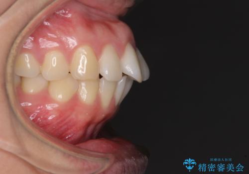 前歯の出っ歯と口の閉じにくさが気になる 目立たないワイヤー装置での抜歯矯正の治療前