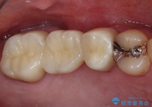 放置した奥歯の虫歯　セラミックブリッジによる補綴治療