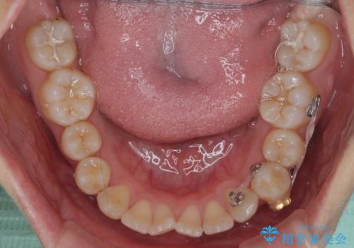 前歯のがたつき　部分矯正でコストダウンしながら、かみ合わせも治療の治療中