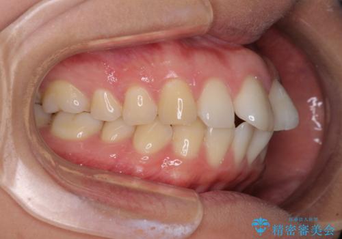 前歯の出っ歯と口の閉じにくさが気になる　目立たないワイヤー装置での抜歯矯正の治療前